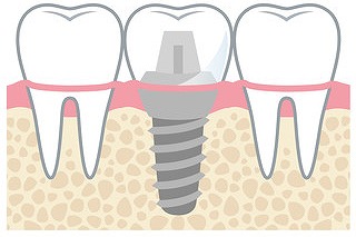 インプラント